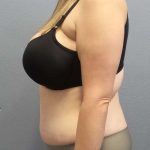 Abdominoplasty Before & After Patient #3881