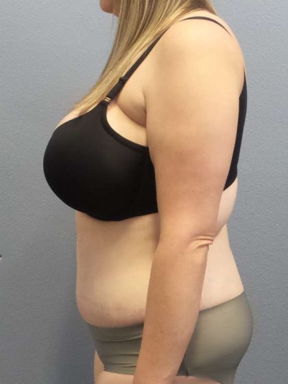 Abdominoplasty Before & After Patient #3881