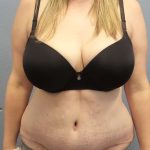 High BMI (Larger Patients) Surgery Before & After Patient #10482