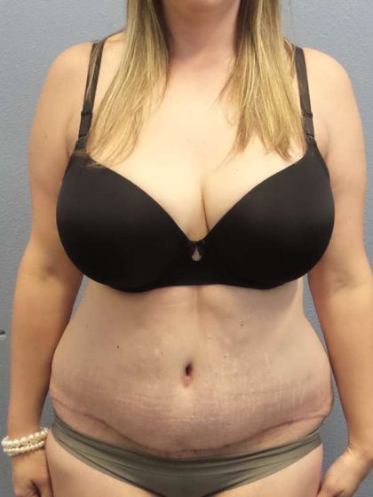 High BMI (Larger Patients) Surgery Before & After Patient #10482