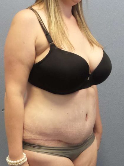 Abdominoplasty Before & After Patient #3881