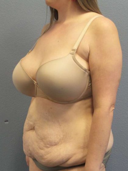 High BMI (Larger Patients) Surgery Before & After Patient #10482
