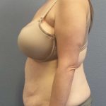 Abdominoplasty Before & After Patient #3881