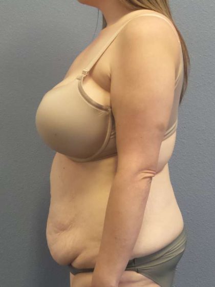 High BMI (Larger Patients) Surgery Before & After Patient #10482