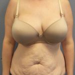 Abdominoplasty Before & After Patient #3881