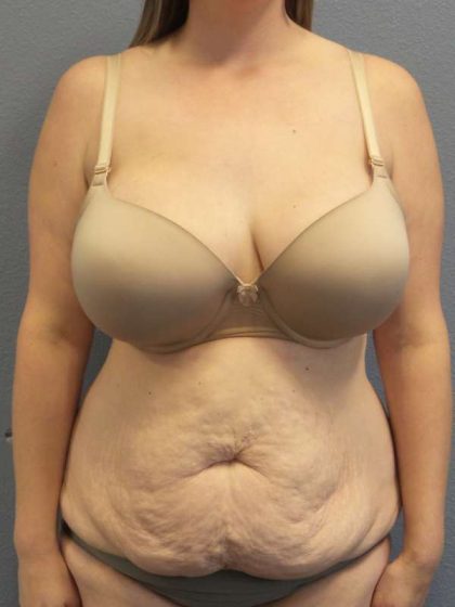 Abdominoplasty Before & After Patient #3881