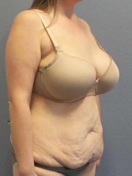 Abdominoplasty Before & After Patient #3881