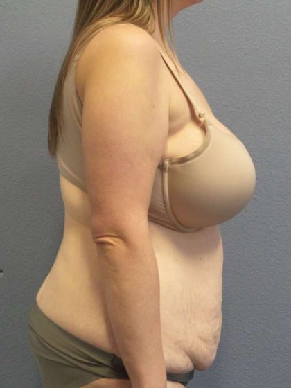 Abdominoplasty Before & After Patient #3881
