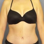 Abdominoplasty Before & After Patient #3708