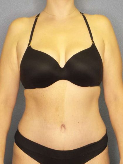 Abdominoplasty Before & After Patient #3708