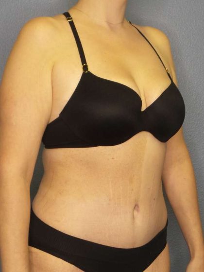 Abdominoplasty Before & After Patient #3708