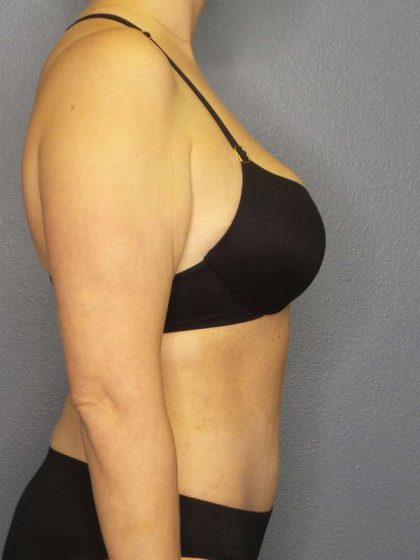 Abdominoplasty Before & After Patient #3708