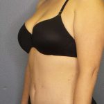Abdominoplasty Before & After Patient #3708