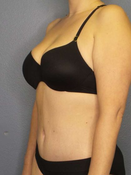 Abdominoplasty Before & After Patient #3708