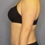 Abdominoplasty Before & After Patient #3708