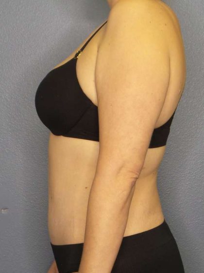 Abdominoplasty Before & After Patient #3708