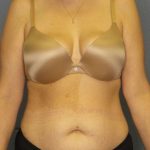 Abdominoplasty Before & After Patient #3708