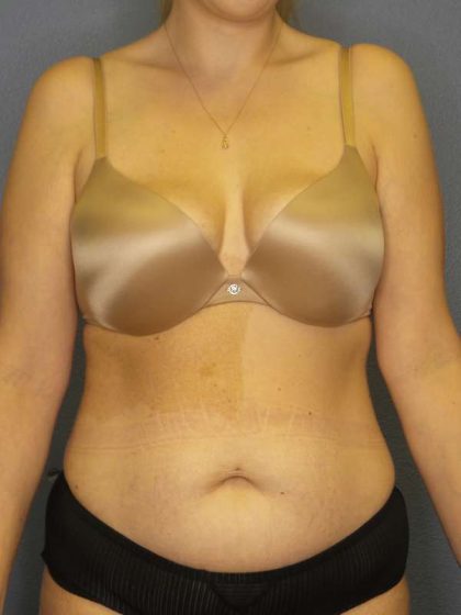 Abdominoplasty Before & After Patient #3708