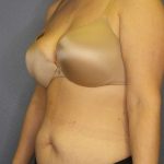 Abdominoplasty Before & After Patient #3708