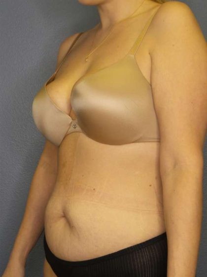 Abdominoplasty Before & After Patient #3708