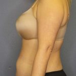 Abdominoplasty Before & After Patient #3708