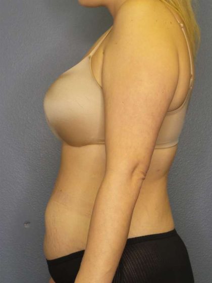 Abdominoplasty Before & After Patient #3708