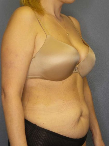 Abdominoplasty Before & After Patient #3708