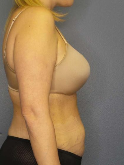 Abdominoplasty Before & After Patient #3708