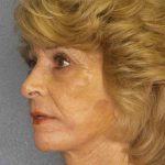 Facelift Before & After Patient #7519