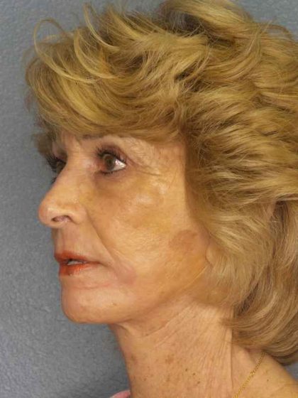 Facelift Before & After Patient #7519
