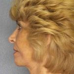 Facelift Before & After Patient #7519