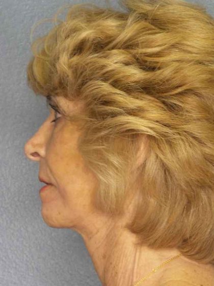 Facelift Before & After Patient #7519