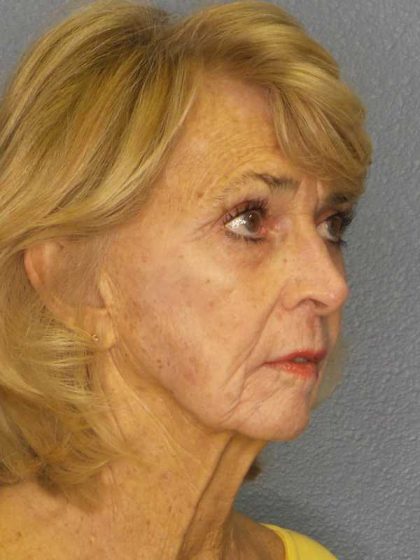 Facelift Before & After Patient #7519