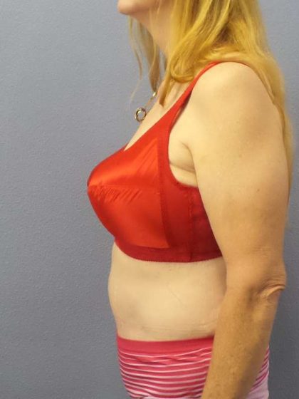 Abdominoplasty Before & After Patient #3681