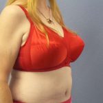 Abdominoplasty Before & After Patient #3681