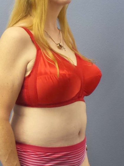 Abdominoplasty Before & After Patient #3681