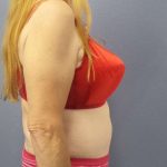 Abdominoplasty Before & After Patient #3681