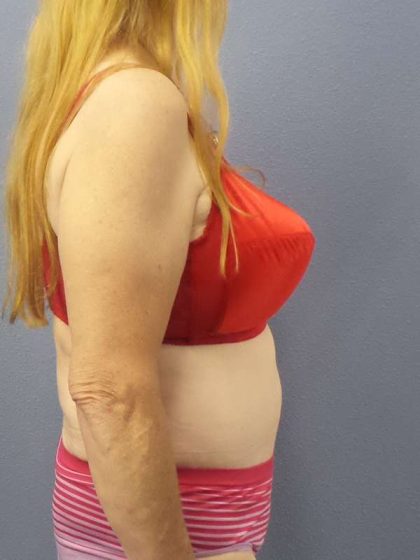 Abdominoplasty Before & After Patient #3681