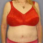 Abdominoplasty Before & After Patient #3681