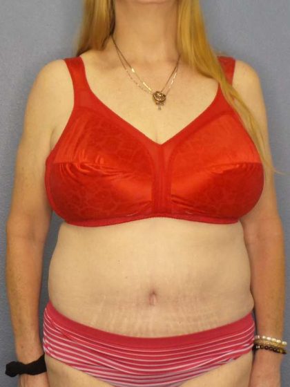 Abdominoplasty Before & After Patient #3681