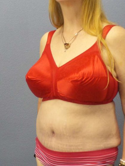 Abdominoplasty Before & After Patient #3681