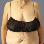 Abdominoplasty Before & After Patient #3681
