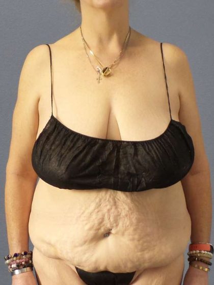 Abdominoplasty Before & After Patient #3681