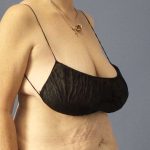 Abdominoplasty Before & After Patient #3681