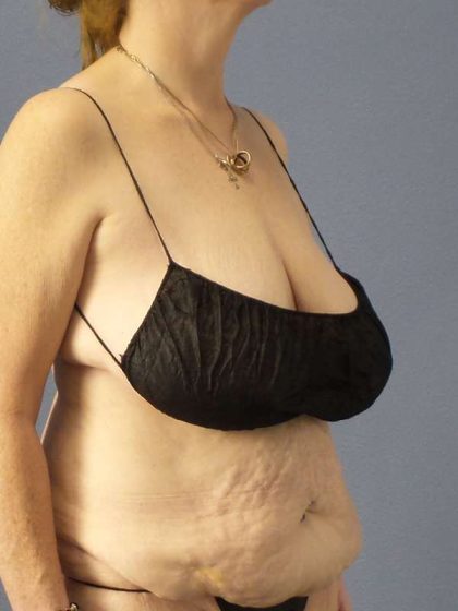 Abdominoplasty Before & After Patient #3681