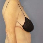 Abdominoplasty Before & After Patient #3681