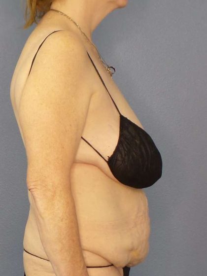 Abdominoplasty Before & After Patient #3681