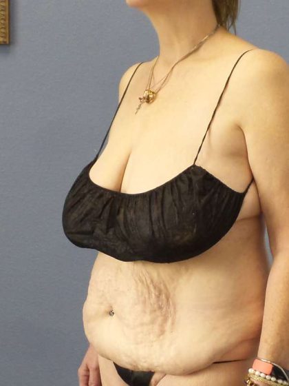 Abdominoplasty Before & After Patient #3681