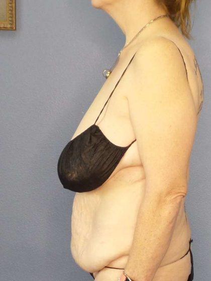 Abdominoplasty Before & After Patient #3681