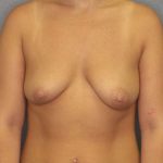 Asymmetric (Uneven) Breasts Before & After Patient #5592